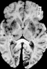 Bilateral hemorrhagic infarcts, lenticulostriate and thalamoperforant  circulations